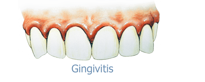 gingivitis