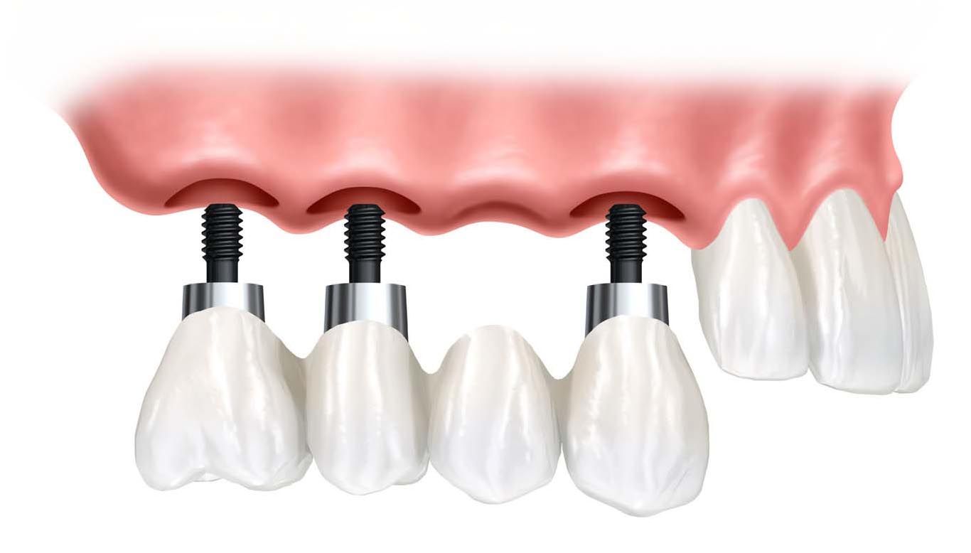 implante dental birbe